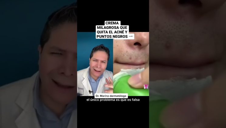 CREMA MILAGR0S@ QUE QUITA EL ACNÉ Y PUNTOS NEGROS.